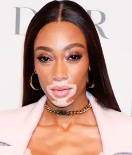 Winnie Harlow pesos Brady Peso della dimensione delle statistiche del corpo